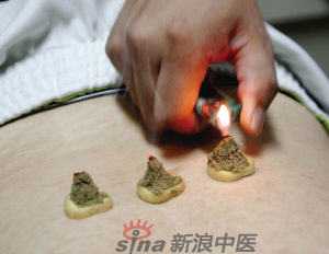 灸法的種類  你知道多少？